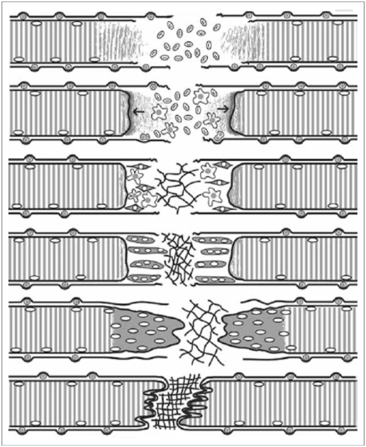 Image of a muscle strain, where the myofibers are being exposed to an excessive tensile force that causes a shearing injury.