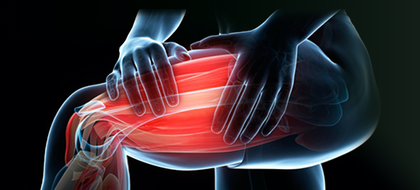 Visualization of a muscle strain